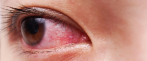 What is normal after an eye injection?