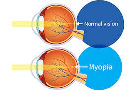 Myopia (short-sightedness) progression