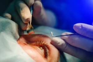 One eye at a time (staged bilateral cataract surgery)