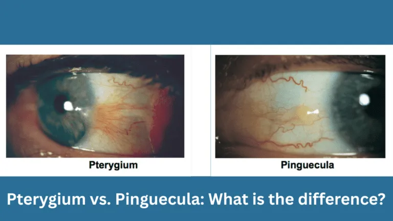 Pterygium vs Pinguecula: What is the difference?