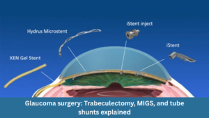 Glaucoma surgery: trabeculectomy, MIGS, and tube shunts explained