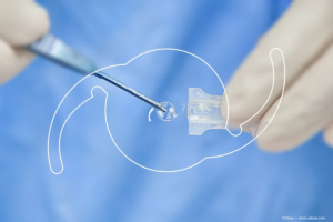 Why toric IOLs work better than older techniques to reduce astigmatism?