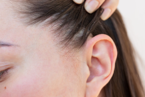 Skin conditions