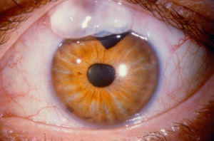 Trabeculectomy