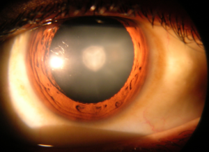 Smoking increases the risk of cataracts