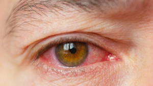 3. Dry eye syndrome