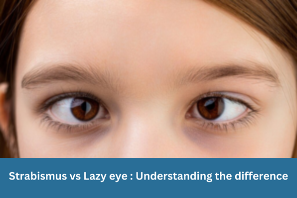 Strabismus vs Lazy eye Understanding the difference