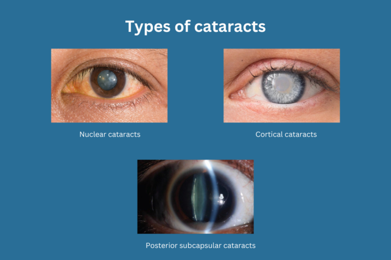 Types of cataracts: