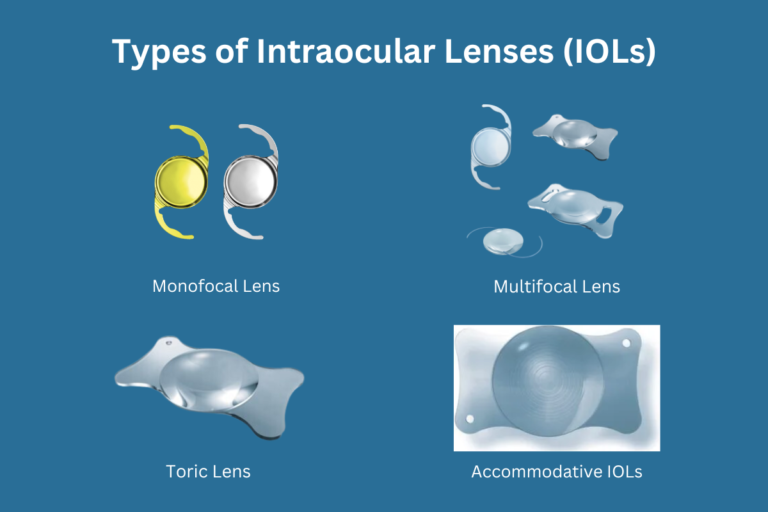 Types of Intraocular Lenses (IOLs)