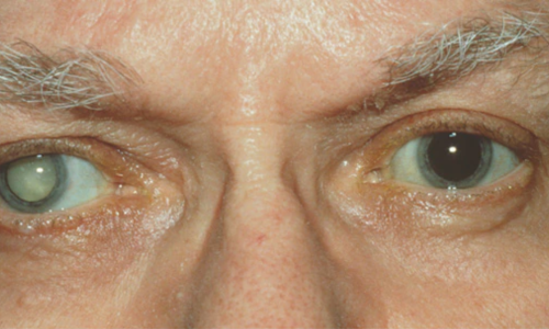 Cataracts Cataracts